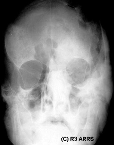 Welcome To LearningRadiology Radiology Radiologic Imaging Sign 